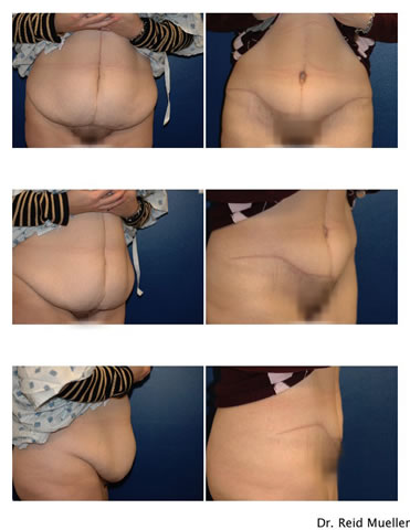 Hysterectomy Scars Pictures